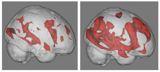 Scan of the active areas of the brain